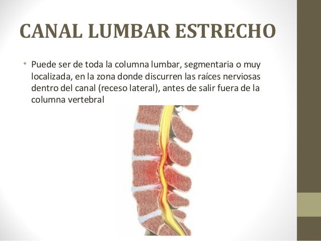 sindrome de canal estrecho lumbar